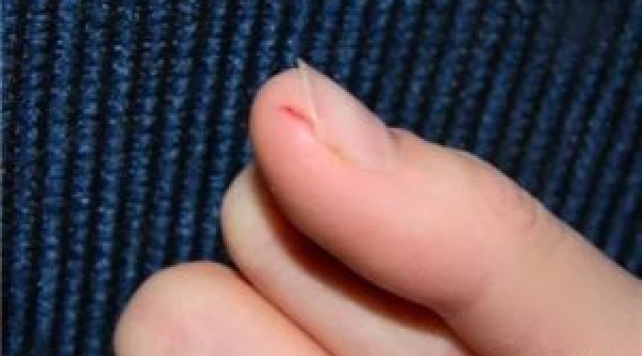 Причины и методы лечения глубоких трещин на пальцах рук