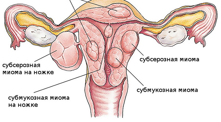 Признаки и лечение субсерозной миомы матки — эффективная терапия и симптомы