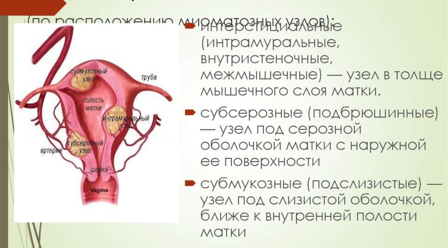 Признаки и методы лечения миоматозного узла