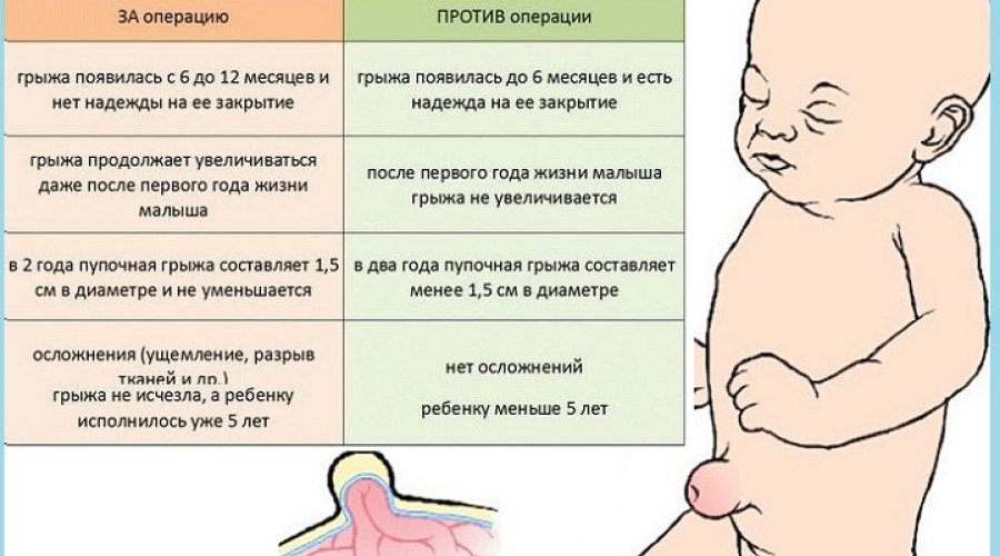 Пупочная грыжа у новорожденных: симптомы, причины, лечение