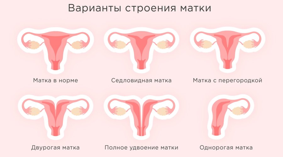 Седловидная матка: причины, диагностика и возможность зачатия