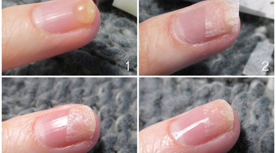 Секреты быстрой починки сломанного ногтя в домашних условиях