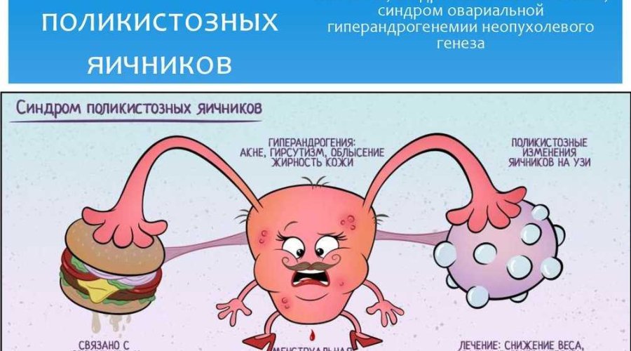 Симптомы и эффективное лечение поликистоза яичников