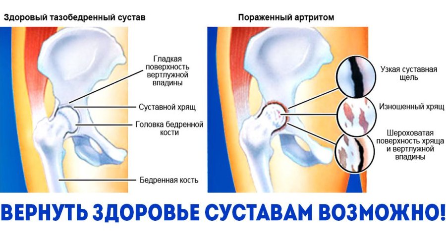 Симптомы и лечение артрита тазобедренного сустава у детей