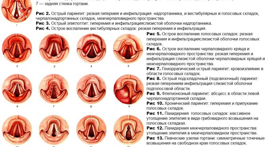 Симптомы и лечение ларингита у детей | Полезная информация и советы