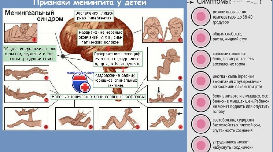 Симптомы и лечение менингококковой инфекции у детей