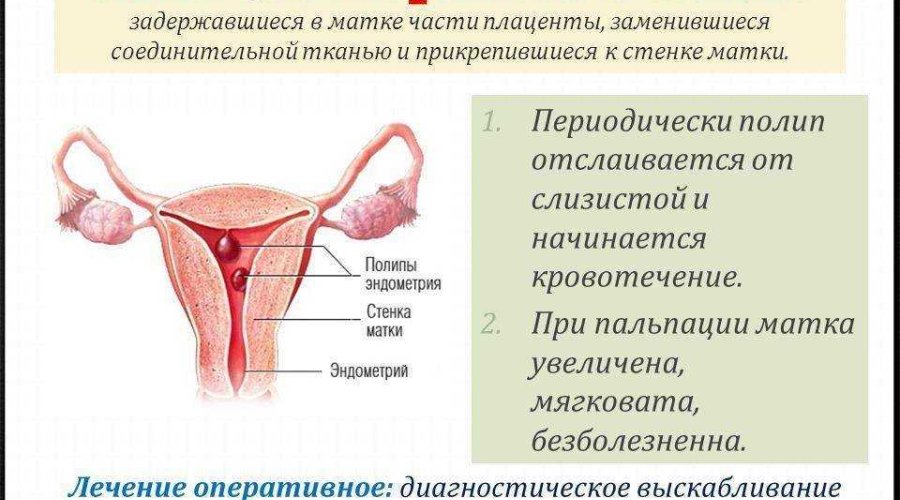 Симптомы и лечение плацентарного полипа после родов