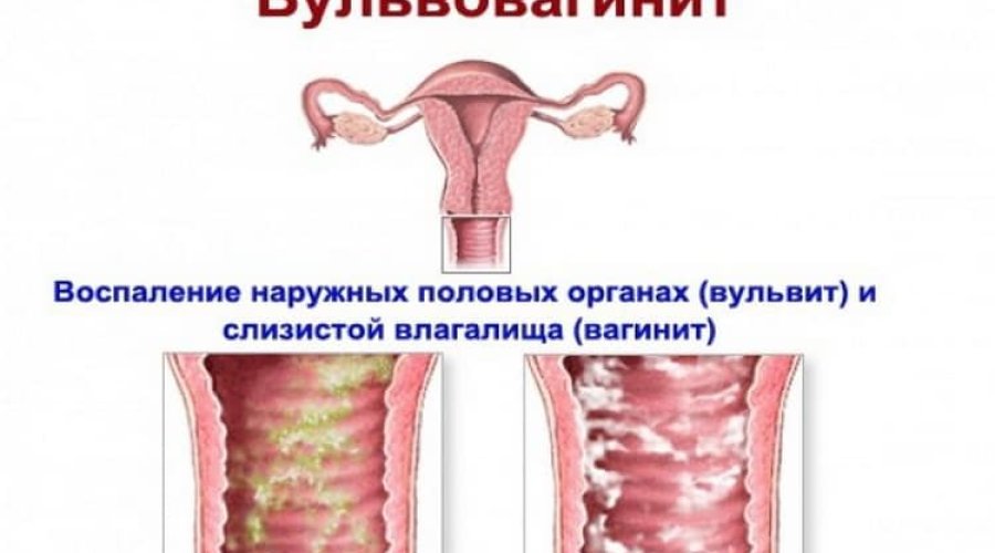 Симптомы и лечение вульвовагинита у девочек: полезная информация