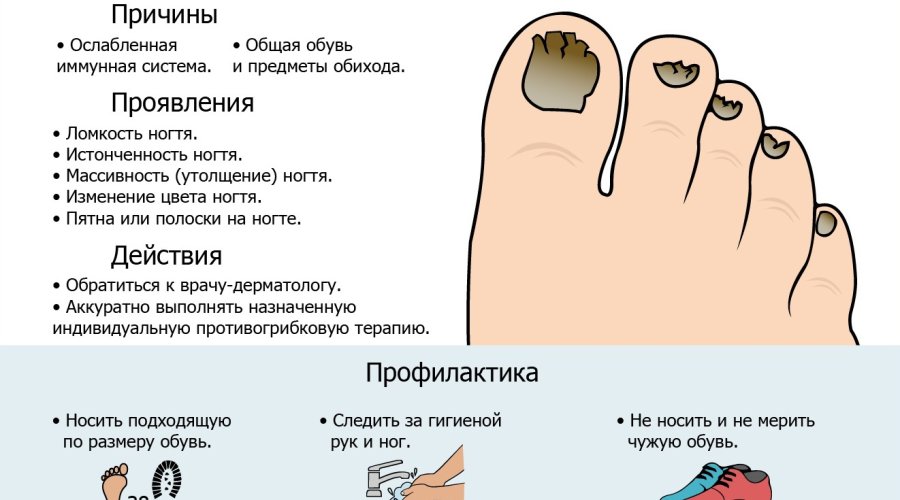 Симптомы и причины грибка ногтей у детей: основные признаки и возможные причины