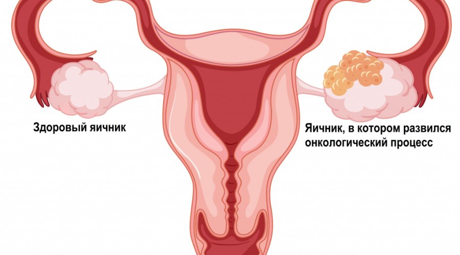 Симптомы, причины и методы лечения рака яичников у женщин