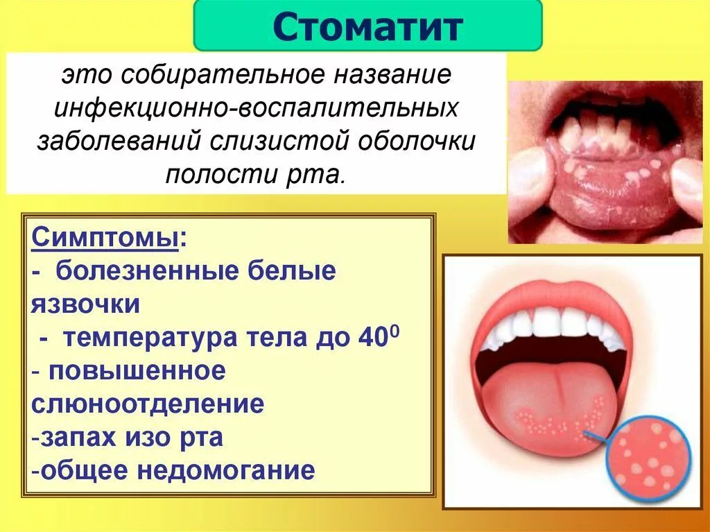 Стоматит при беременности: причины, симптомы и методы лечения