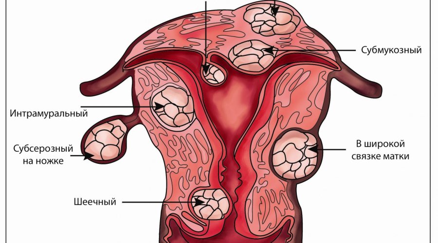 Субмукозный узел в матке: симптомы, причины и методы лечения