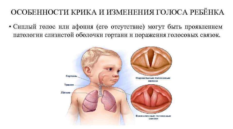 У ребенка пропадает голос: причины и методы лечения