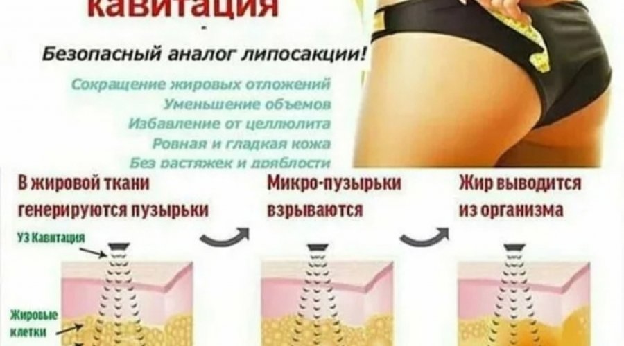 Ультразвуковая кавитация для эффективного похудения без хирургического вмешательства