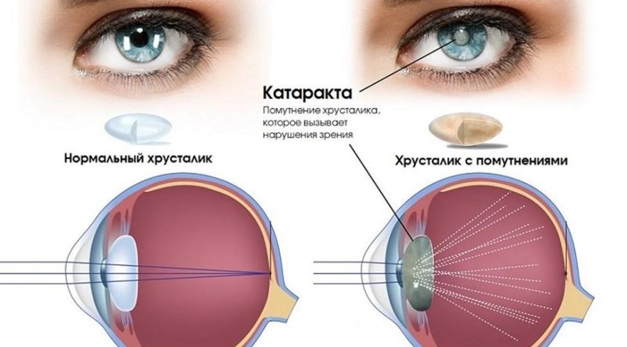 Увидеть вещи по-новому: причины и лечение катаракты во взрослом возрасте.