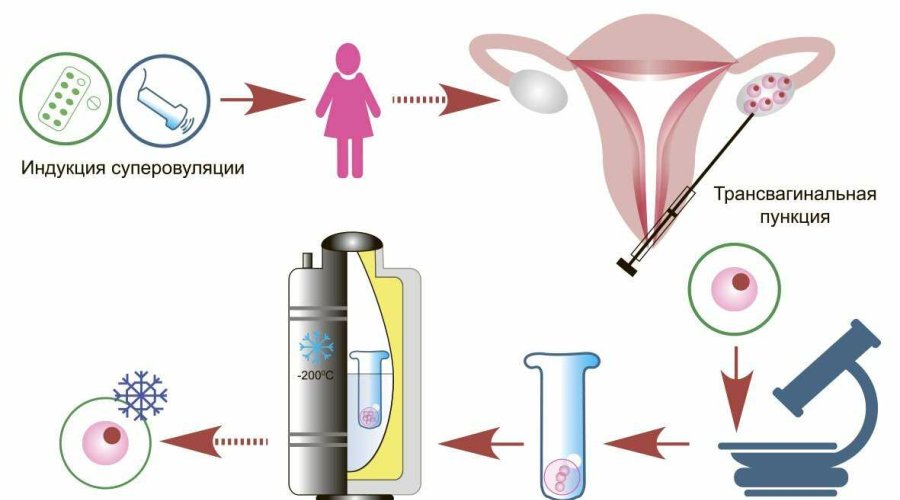 Витрификация эмбрионов: показания и особенности процедуры