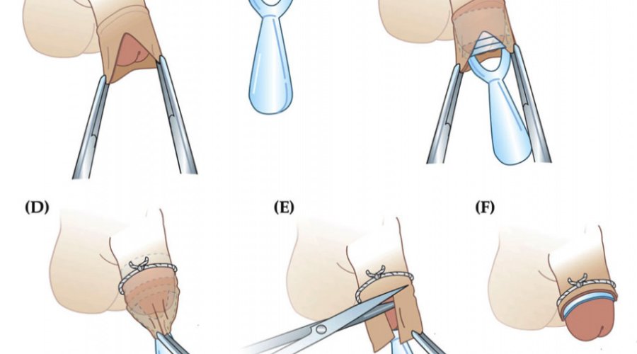 Зачем делают обрезание у мальчиков